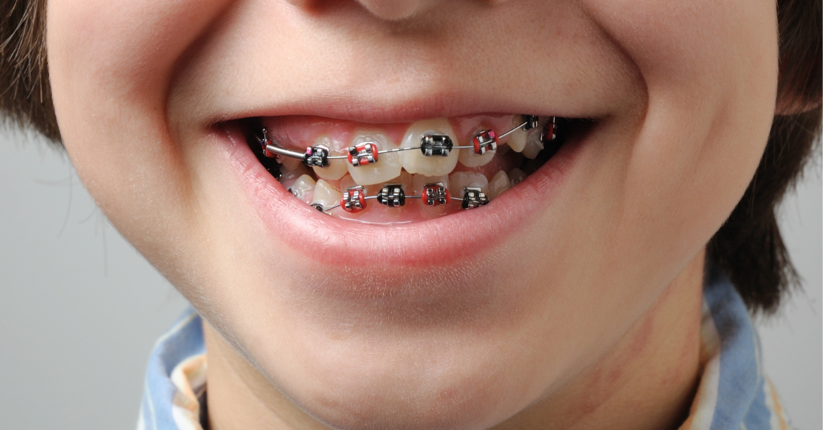 Can Kids' Teeth Move After Braces? What to expect